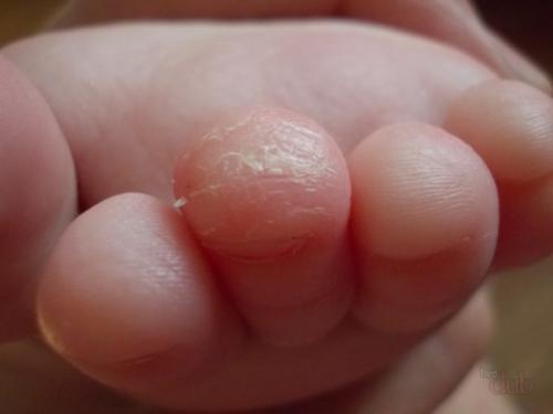 У ребенка облазит кожа на пальцах ног комаровский. Почему шелушатся пальчики у детей?