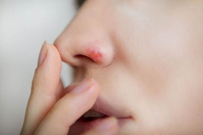 Симптомы герпеса на носу