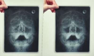 Гайморит на рентгеновском снимке