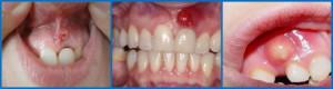 Что делать, если на десне над зубом появилась шишка: фото и лечение гнойных и твердых уплотнений