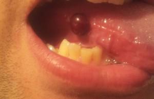 Кровяной прозрачный пузырь на щеке во рту: фото водянистого шарика и способы лечения волдырей на слизистой оболочке