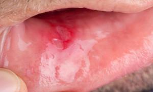 Кровяной прозрачный пузырь на щеке во рту: фото водянистого шарика и способы лечения волдырей на слизистой оболочке