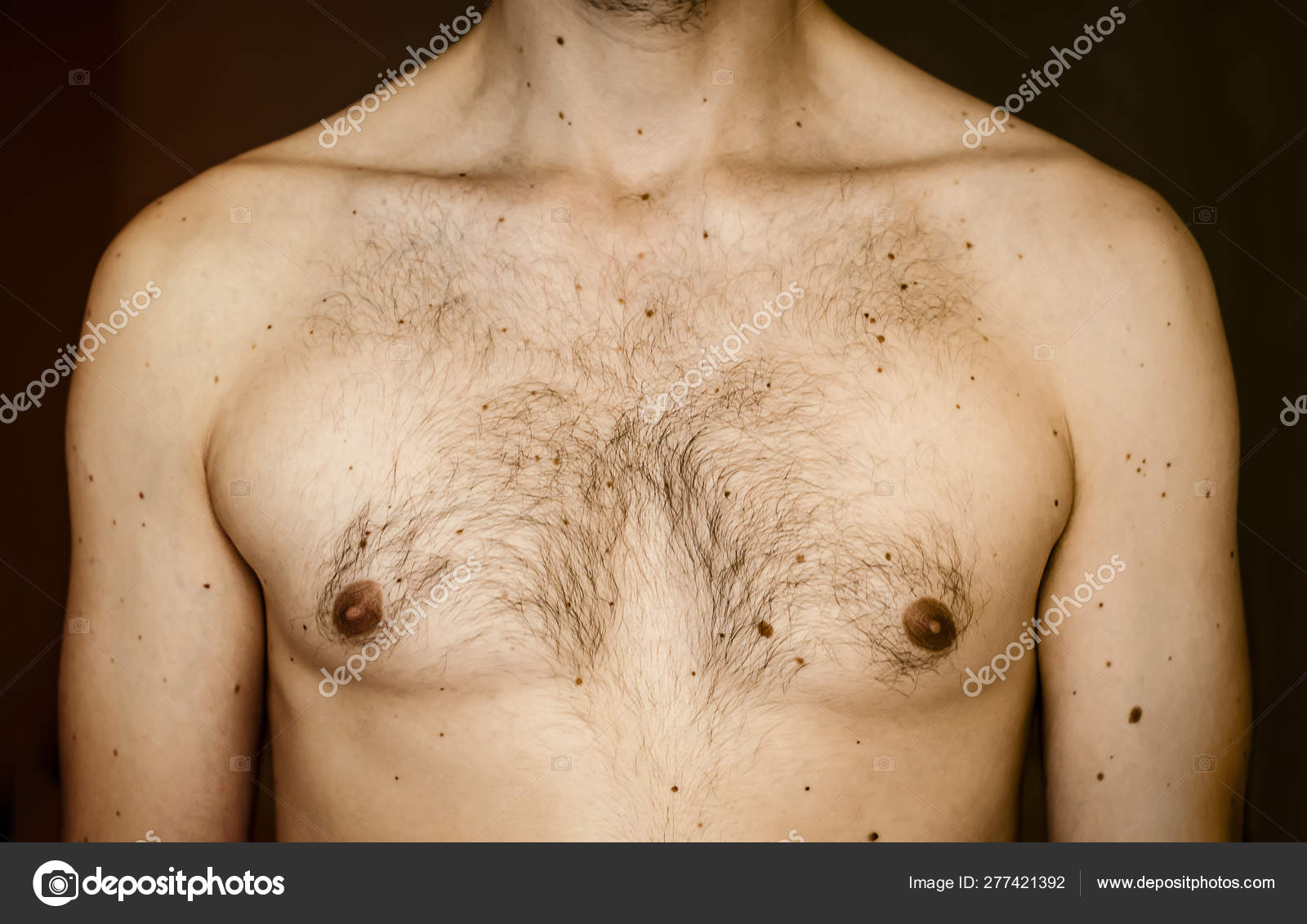 подкожные прыщи на груди у мужчин фото 1