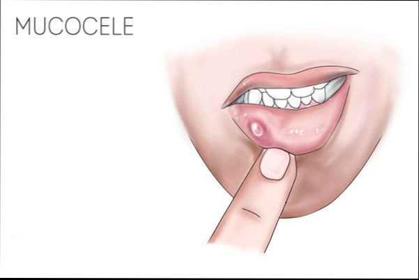 mucocele