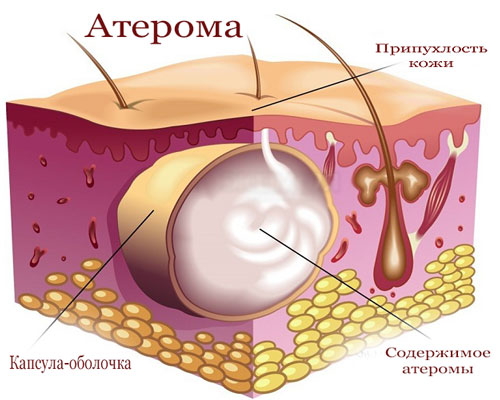 Атерома