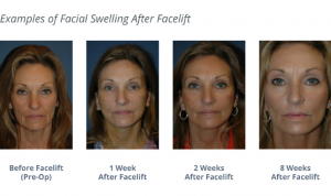 Facial Swelling After Facelift Before and After