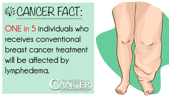 Cancer-Fact-Lymphedema