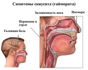 Симптомы синусита