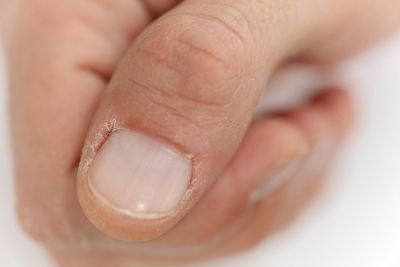 skin around nails peeling