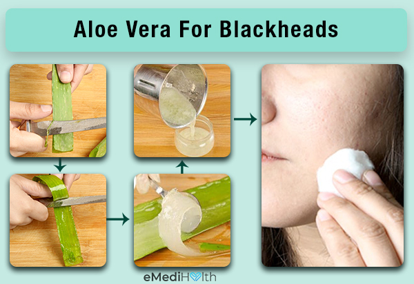 use aloe vera for curbing the growth of blackheads