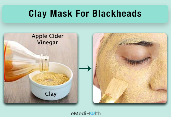 clay mask can help curb blackheads