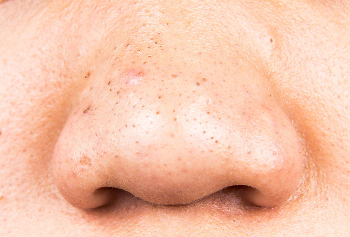 at-home remedies for blackheads