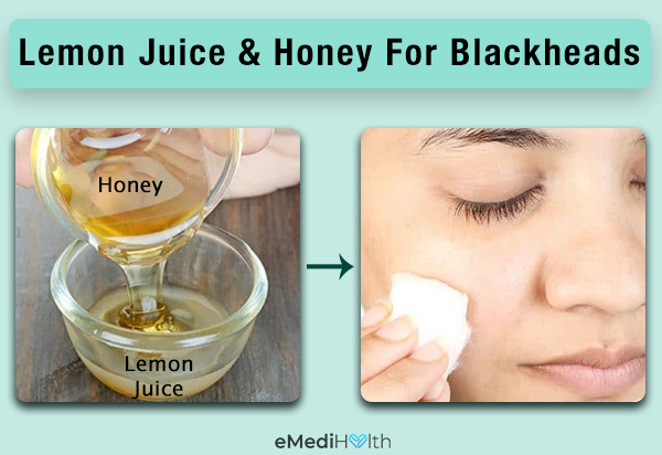 lemon juice and honey application can help prevent blackheads