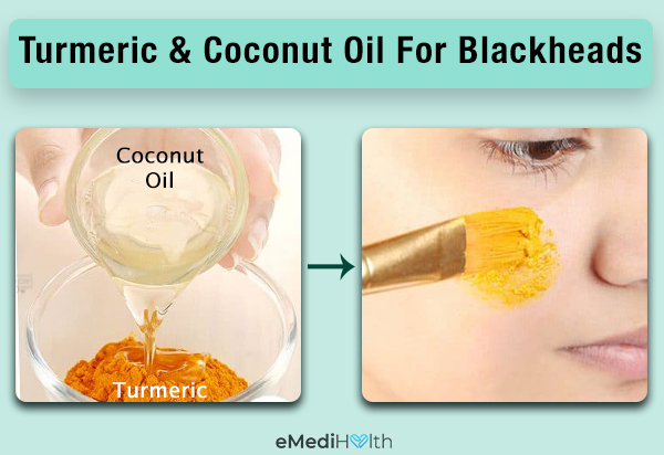 apply turmeric and coconut oil to prevent blackheads
