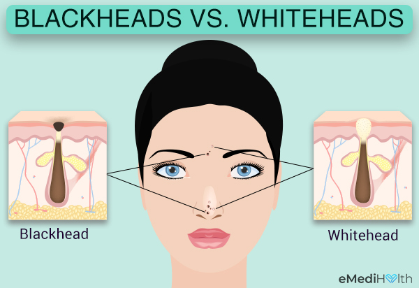 blackheads versus whiteheads