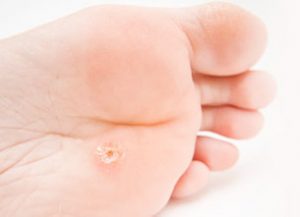 Plantar Wart, University Foot and Ankle Institute Los Angeles