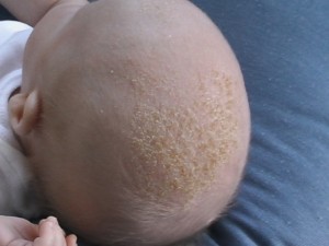 cradle cap