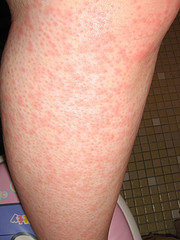 Cholinergic (physical) urticaria on the leg