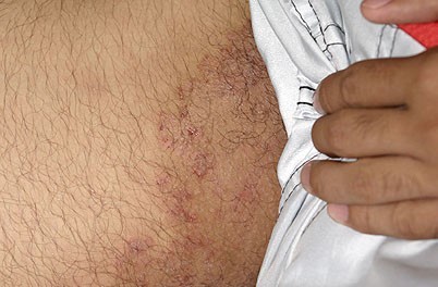 fungal infection of the groin tinea cruris