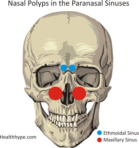 Nasal Polyps in the Paranasal Sinuses
