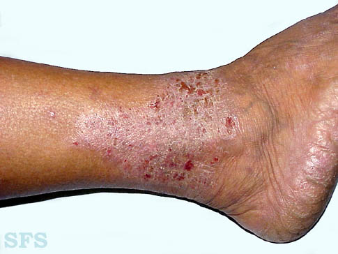 Stasis (gravitational) eczema