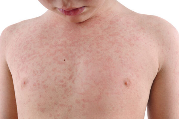 Rashes have many causes (Thinkstock/PA)