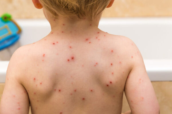 A toddler with chickenpox (Thinkstock/PA)