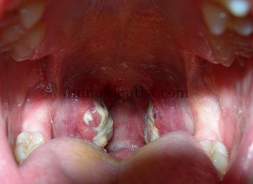 Tonsillitis clinical features signs and symptoms and treatment