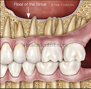 Sinusitis caused by tooth infection