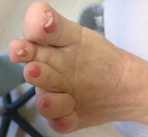 White Spots & White Chalky nails from toenail polish