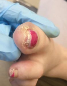 White spots under the toenails keratin granulations