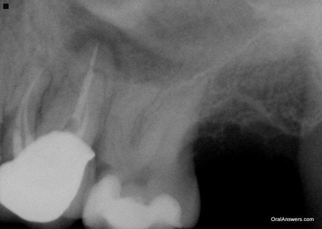 Abscess Near Sinus in a Molar