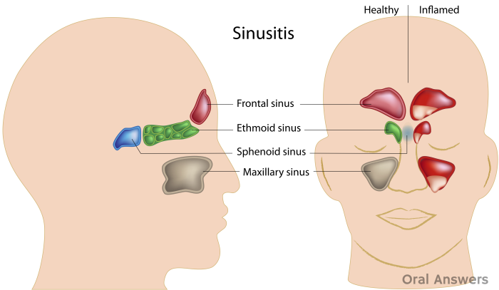 How Sinusitis Can Cause a Toothache