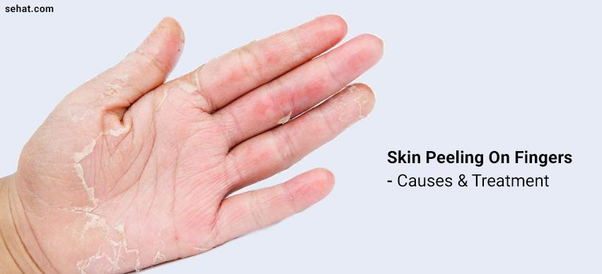 Skin Peeling On Fingers - Causes And Treatment