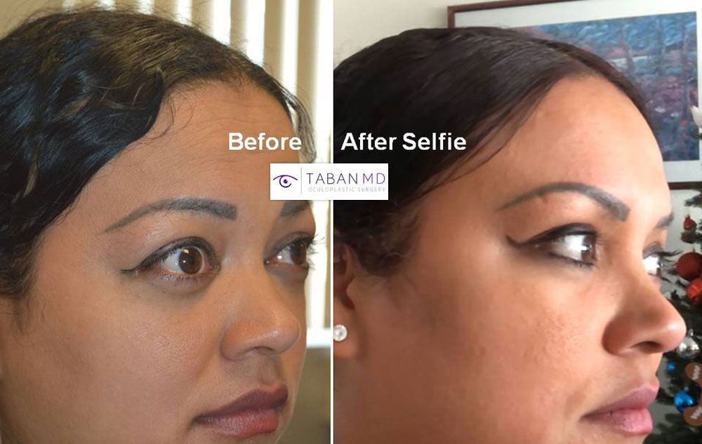 Young woman, with bulging eyes due to Graves thryoid eye disease, underwent scarless orbital decompression surgery, to restore more natural eye appearance and improved eye closure.