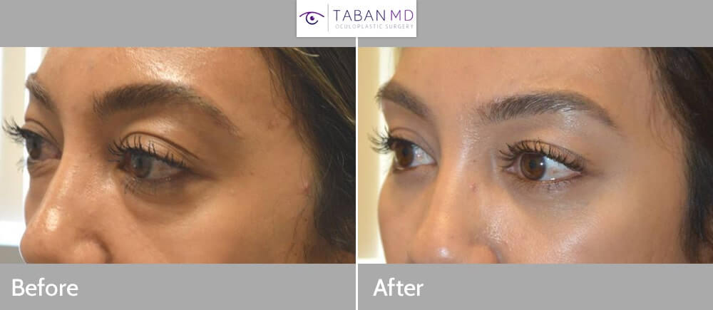 Orbital decompression page and gallery: Beautiful woman, affected by Graves thyroid eye disease causing bulging eyes and eye fat bags, underwent scarless orbital decompression and lower blepharoplasty. Note more natural and rested eye appearance in after photo 1 month after surgery.