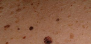 mole-on-arm-cancer-symptom