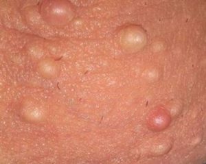 white-pimple-like-bumps-on-testicle-sac