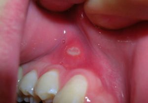 Canker Sores in Mouth and Gums