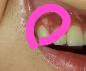 Image of White Bump on Gum Above Tooth