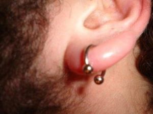 Ear Lobe Piercing Swollen