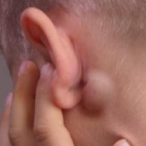 Swollen Lymph Nodes behind Ear Picture