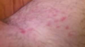Rash on Groin Scrotum area Picture