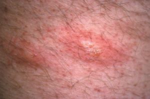 Signs of Herpes on Scrotum Skin