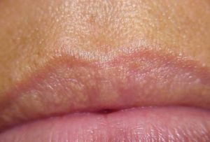 Small Bumps on Lips - Fordyce Spots
