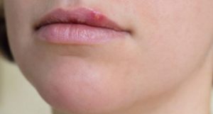Tiny Bump on Lips-Picture