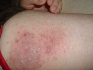 Bumps on Inner Thigh