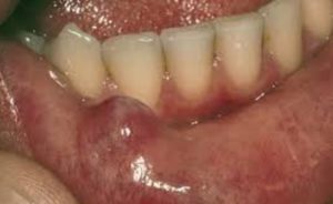 Mucous on Lip Picture