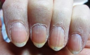 Dry Skin around Fingernails