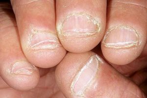 Dry Skin around Nails